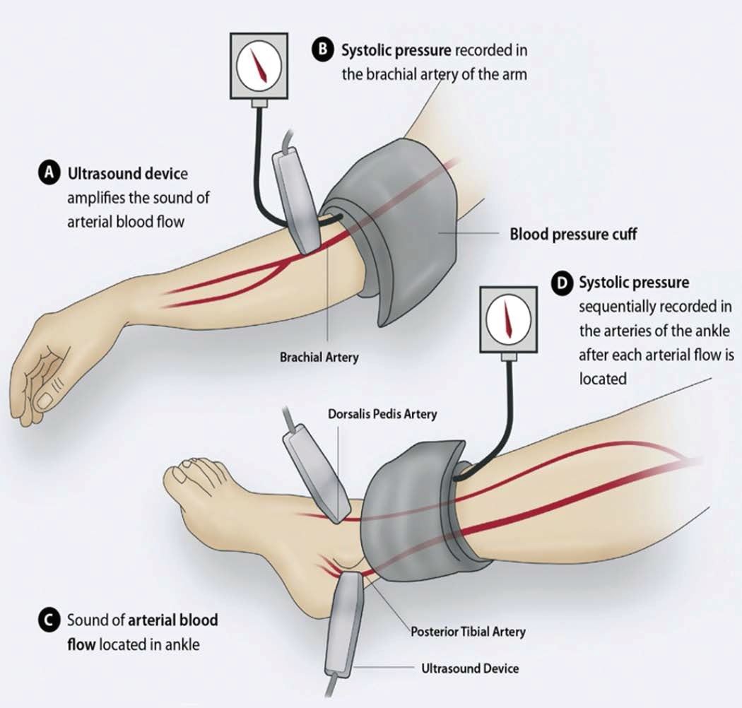 Ankle Brachial Index